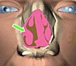 Гипертрофия носовых раковин