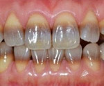 Тетрациклиновые зубы 