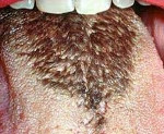 Черный волосатый язык после антибиотиков