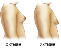 Гинекомастия