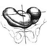 Беременность положение плода продольное. Поперечное положение плода: причины, операция. Причины осложнения родов при поперечном положении плода