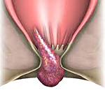 Выпадение геморроидальных узлов