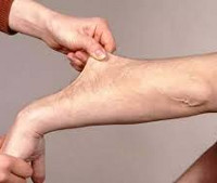 Ehlers-Danlos-Syndrom