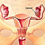 Рак правого яичника у женщин 30