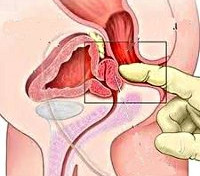 Процедура Массаж простаты
