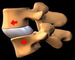 Спондилолистез у детей