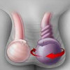 Операция при перекруте семенного канатика