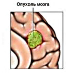 Астроцитома головного мозга Астроцитома головного мозга