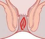 Хроническая анальная трещина