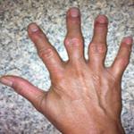 Деформация пальцев рук