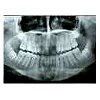 Ортопантомограмма (ОПТГ)