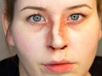 Искривление носа при переломе thumbnail