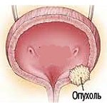 Доброкачественные опухоли мочевого пузыря