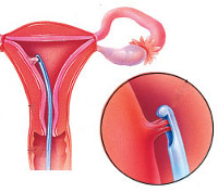Процедура Пайпель-биопсия эндометрия