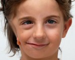 Синдром Гольденхара Синдром Гольденхара
