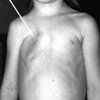 Хирургическая коррекция при врожденных реберно-мышечных дефектах (синдром Поланда)