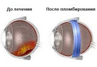 Пломбирование склеры при отслойке сетчатки цена