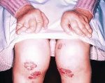 Серонегативные спондилоартриты Серонегативные спондилоартриты