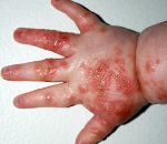 Врожденная герпетическая инфекция