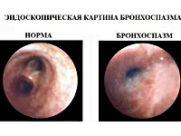 Бронхоспазм