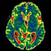 МРТ-диффузия головного мозга