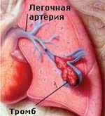 Тромб в легких: симптомы, лечение, последствия