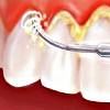 Снятие зубных отложений ультразвуком у детей