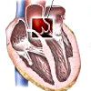 Пластика аортального клапана