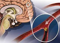 Атеросклероз сосудов головного мозга