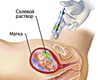 Процедура Искусственные роды