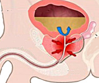Простата задержка мочи