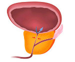 Доброкачественная гиперплазия предстательной железы