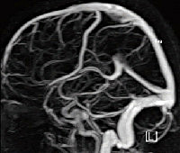 Процедура МРТ сосудов головного мозга