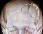 Перелом свода черепа