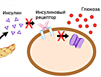 Сахарный диабет 2 типа