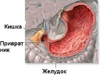 Пилоростеноз