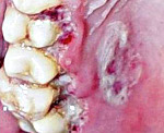 Язвенно-некротический стоматит Венсана