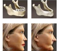 Атрофия костной ткани челюсти