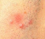 Лимфоплазмоцитарная инфильтрация что это. Смотреть фото Лимфоплазмоцитарная инфильтрация что это. Смотреть картинку Лимфоплазмоцитарная инфильтрация что это. Картинка про Лимфоплазмоцитарная инфильтрация что это. Фото Лимфоплазмоцитарная инфильтрация что это