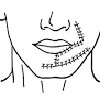 Резекция мягких тканей предверия рта и щеки