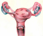 ЭНДОМЕТРИОЗ ⁂ симптомы эндометриоза матки, шейки ▷ фото ▷