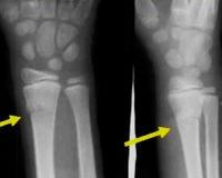 Реферат: Патологические переломы у детей