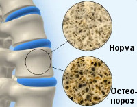 Ювенильный остеопороз