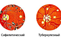 Хориоретинит