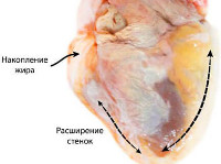 Алкогольная кардиомиопатия