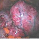 Некроз миоматозного узла при беременности 28