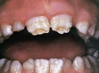 Аномалии зубов
