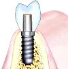 Классическая имплантация 1 зуба