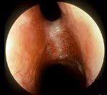 Синехии полости носа