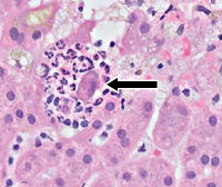 Цитомегаловирусный гепатит